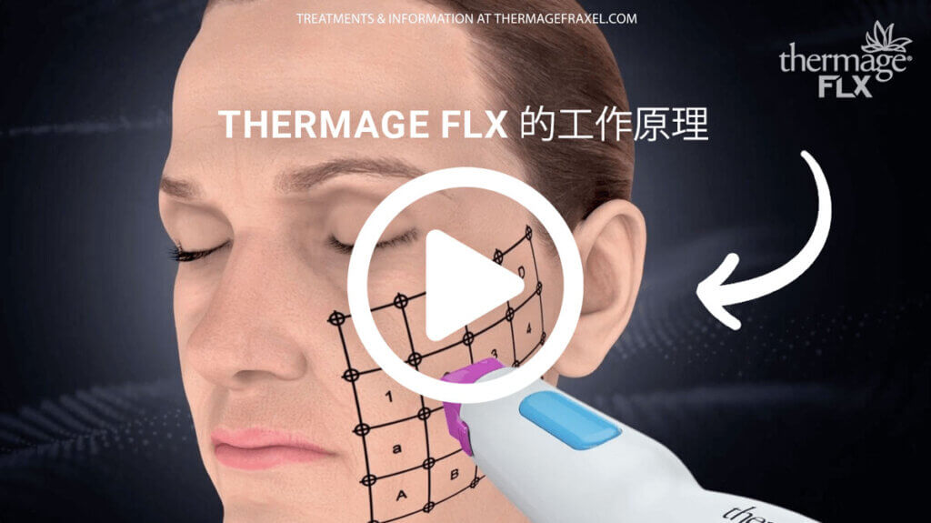 thermage-flx-explain-ch-teaser